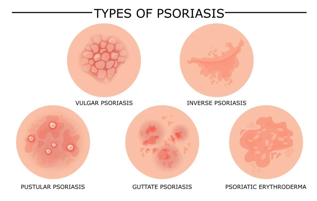 jenis psoriasis